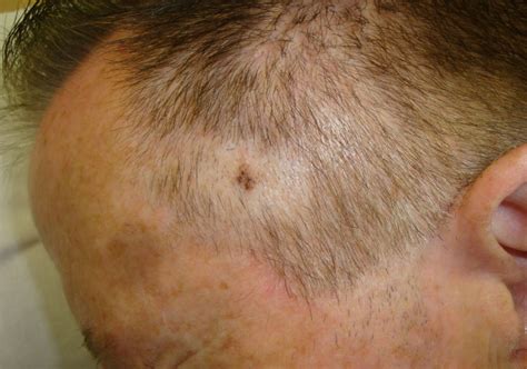 stage 1 melanoma on scalp pictures